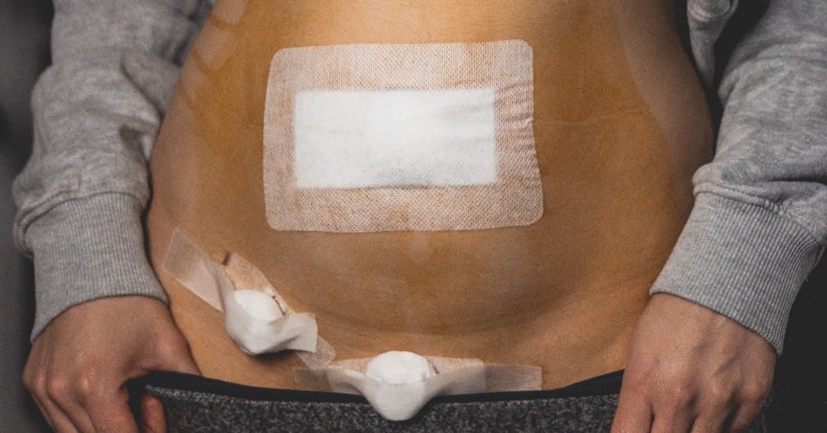 The path to the diagnosis of endometriosis: A personal story